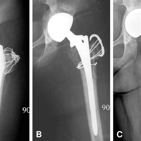Afbeeldingsresultaten voor AAOS Acetabular Defect Classification