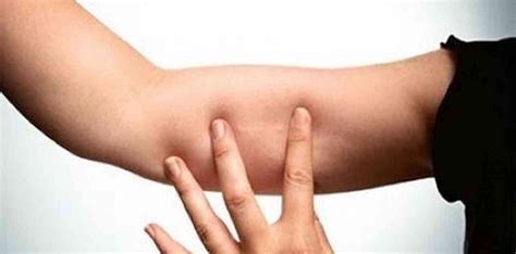 Image result for Implanon Procedure