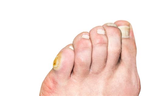 Image result for Corn On Small Toe