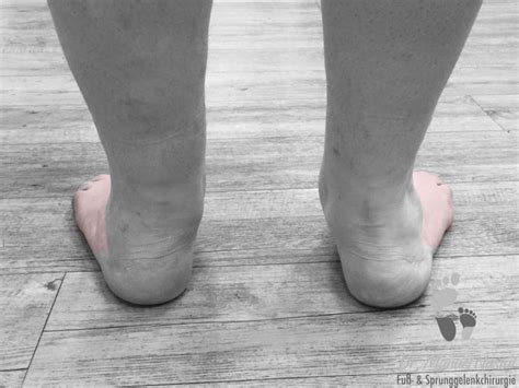 Image result for Pes Planovalgus