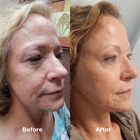 Toradh íomhá ar RF Micro Needling Harrisburg PA