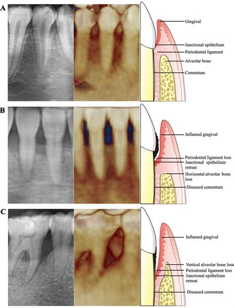 Angular Bone Defect Classification に対する画像結果