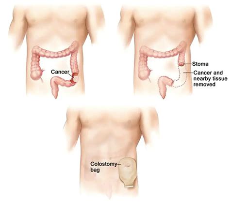 Image result for Types of Colostomy