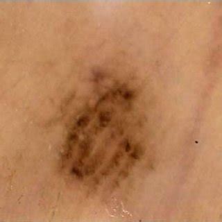 Toradh íomhá ar Parallel Furrow Pattern