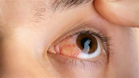 Afbeeldingsresultaten voor Nausea Vision Problems