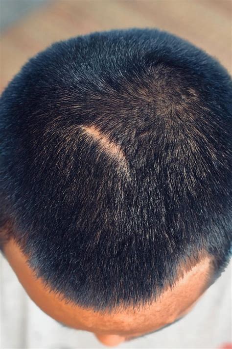 Image result for Scalp Scarring