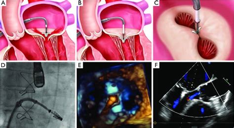 Afbeeldingsresultaten voor MitraClip Ifu