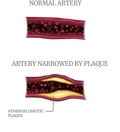 Image result for Narrowed Artery Pad