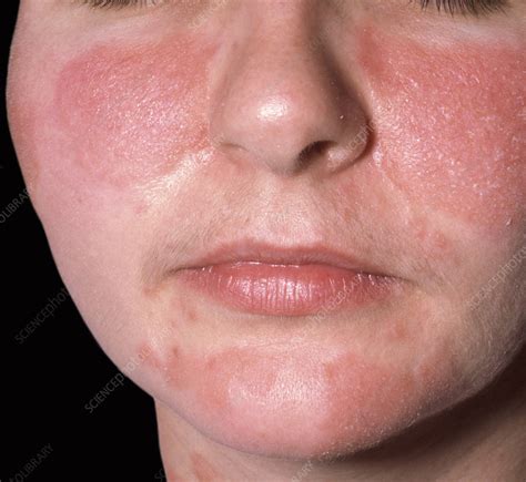 Rhus Dermatitis Face-এর ছবি ফলাফল