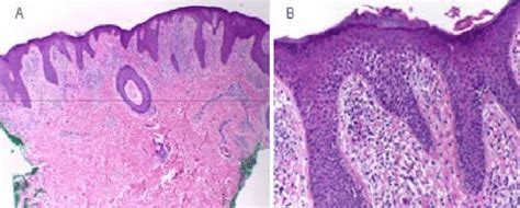 Late-Onset Eczema ਲਈ ਪ੍ਰਤੀਬਿੰਬ ਨਤੀਜਾ