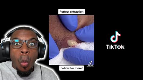 Exploding Pimple Pops に対する画像結果