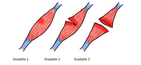 Toradh íomhá ar Hamstring Scheuren