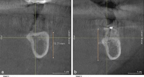 Image result for Overhang Tissue