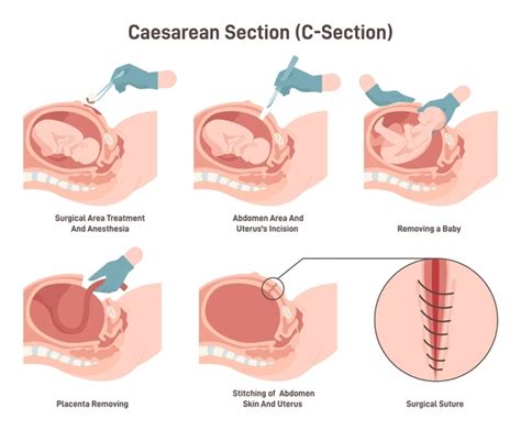 Caesarean Section in Rats に対する画像結果