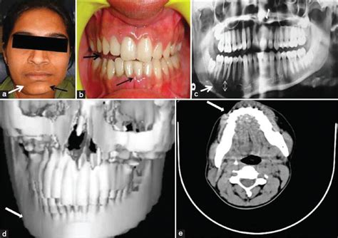 Mandibular Hyperplasia Surgery に対する画像結果