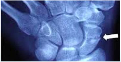 Image result for Navicular Fracture Not Healing