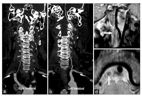 Hypoplastic Vertebral Artery に対する画像結果