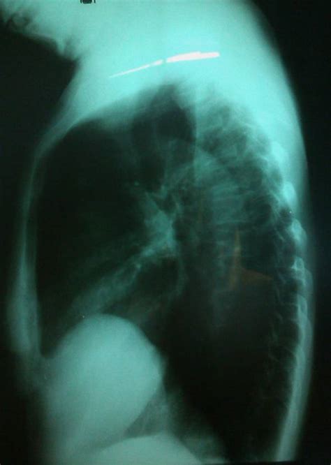 Eventration of Diaphragm CXR に対する画像結果