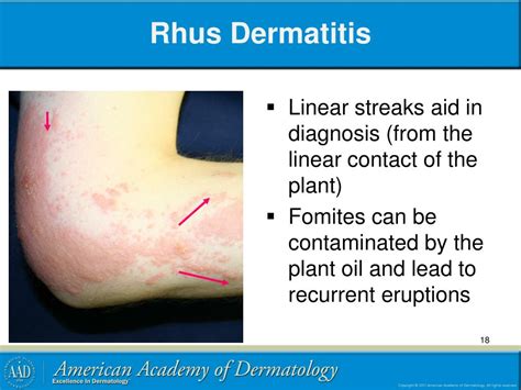 Rhus Dermatitis Face-এর ছবি ফলাফল