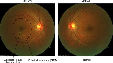 Toradh íomhá ar Fundoscopic Exam Diabetic Retinopathy