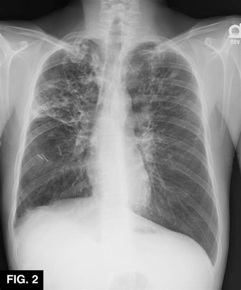 Flat Diaphragm CXR に対する画像結果