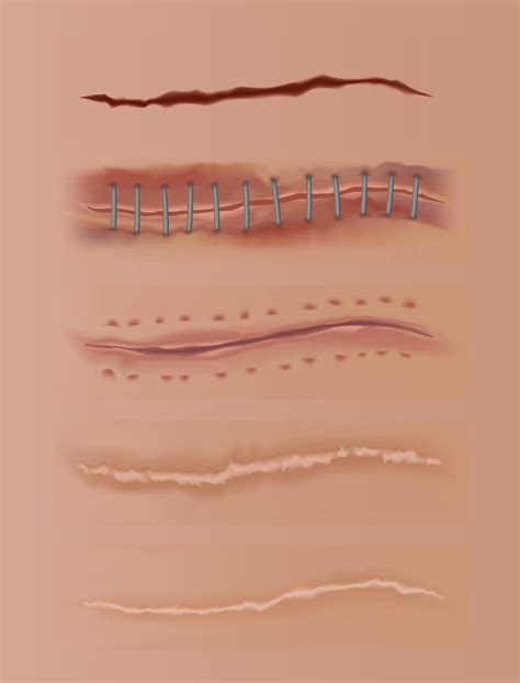 Image result for Scar Tissue Color Curve