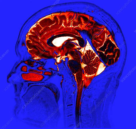 Afbeeldingsresultaten voor Normal Brain MRI Side View