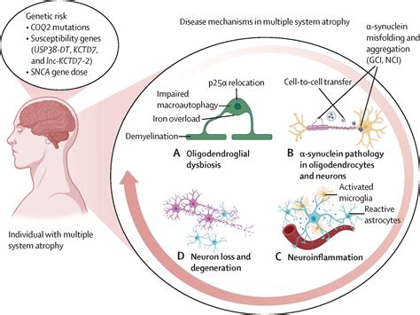 Toradh íomhá ar Multiple System Atrophy