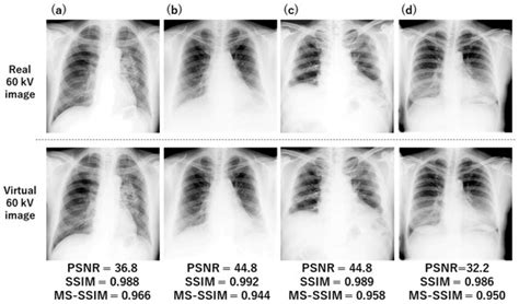 Toradh íomhá ar Dual-Energy Subtraction Algorithm