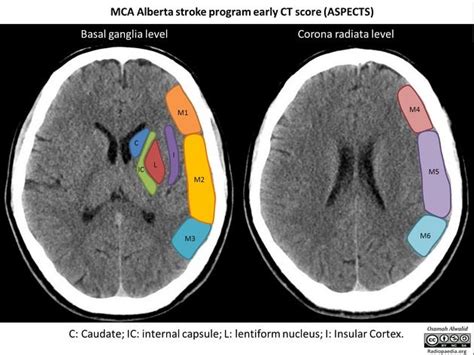 Image result for Peritrigonal Region in CT Brain