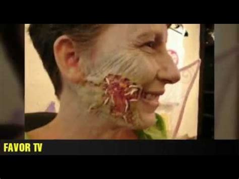 Image result for Mango Worms in Humans