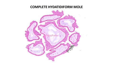 Complete Mole Tissue に対する画像結果