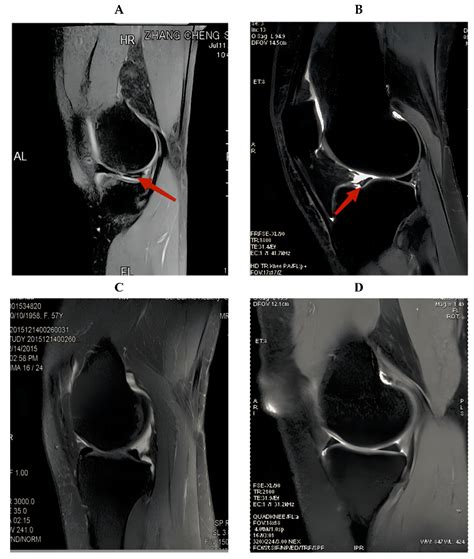 Afbeeldingsresultaten voor Meniscus Visual Inspection Camera