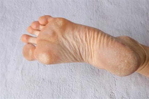 Image result for Caluses Foot