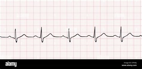 Image result for Normal Vector Cardiogram