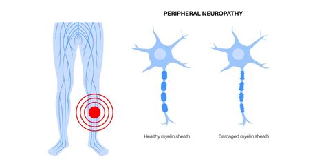 Image result for Peripheral Neuropathy Nerve Diagrams
