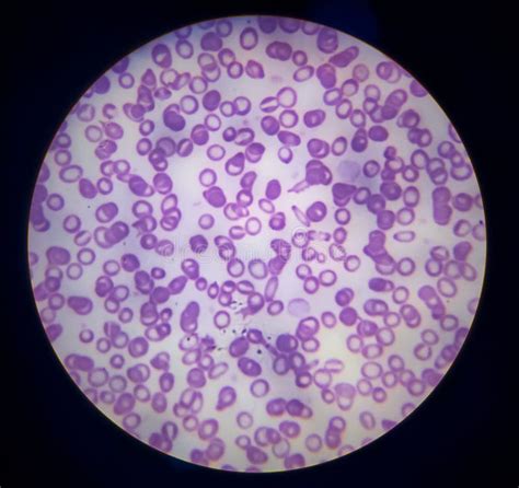 Normal Red Blood Cells Under Microscope-साठीचा प्रतिमा निकाल