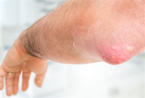 Carbuncle Symptoms に対する画像結果