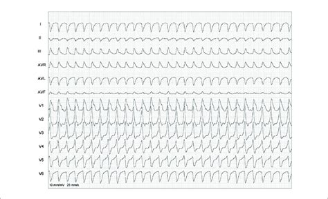 Image result for Wide Complex Tachycardia Algorithm