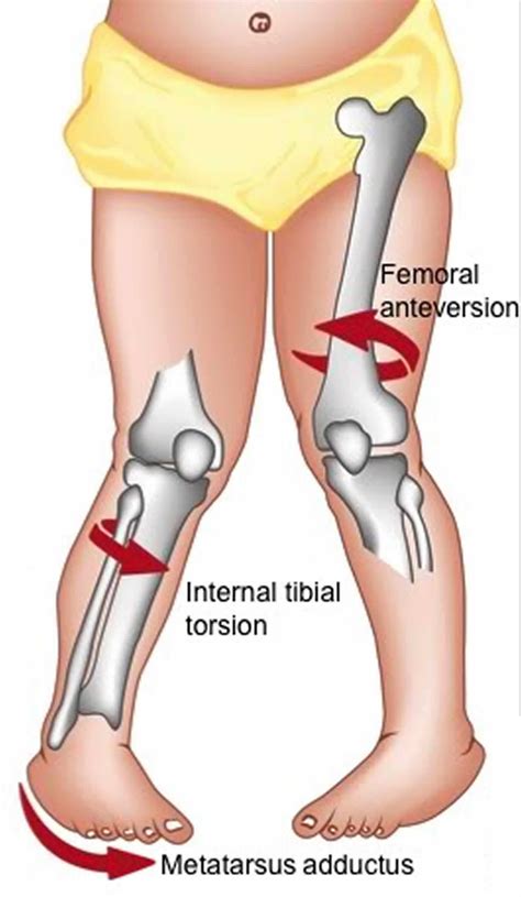 Toradh íomhá ar Femoral Anteversion vs Retroversion