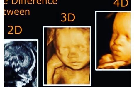 Image result for 3D/4D Ultrasound Exam