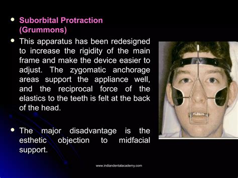 Image result for Maxillary Protraction