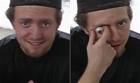 Image result for Eye Pops Out of Socket