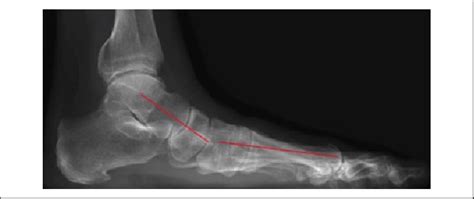 Résultat d’images pour Meary Angle Foot