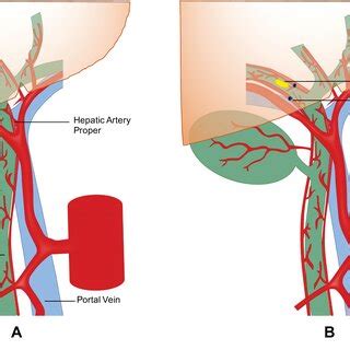 Toradh íomhá ar Liver Back Table Procurement