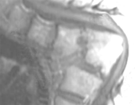 Afbeeldingsresultaten voor Angular Kyphosis TB Spine