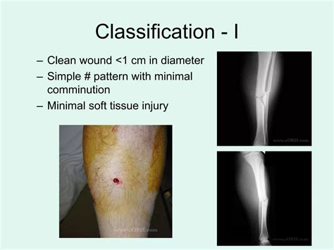 What Is a Open Fracture に対する画像結果