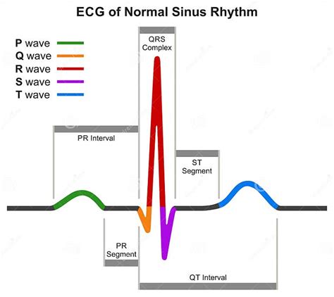 Image result for Sinus Rhythm Diagram