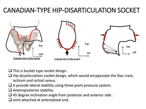 Image result for Disarticulation of Ossicles