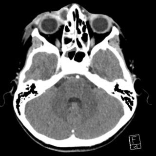 Toradh íomhá ar CT Scan Leg Cellulitis
